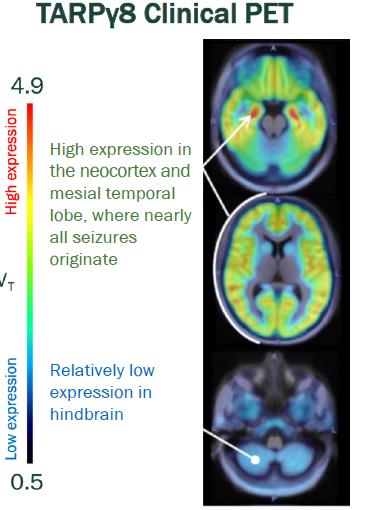 TARP gamma-8 clinical PET imaging showing high expression in the neocortex and mesial temporal lobe